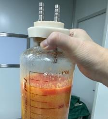梧州水动力吸脂手术要做多久？